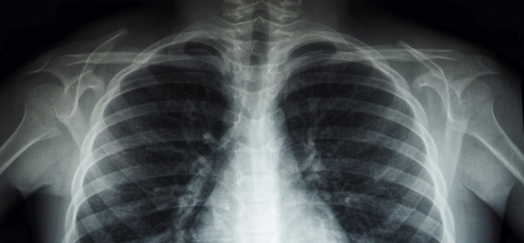 Radiografía de tórax mostrando los pulmones y las costillas claramente definidos