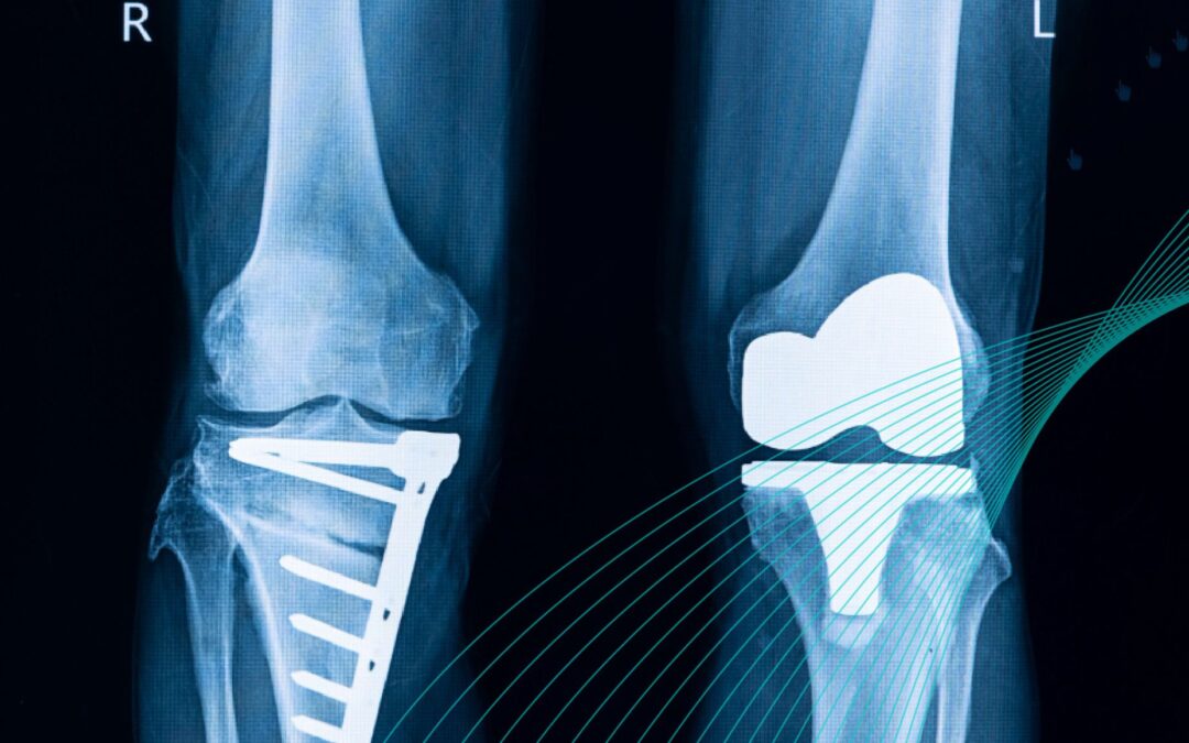 Radiografía de lesión de rodilla que representa el caso del desgarro de Wrisberg