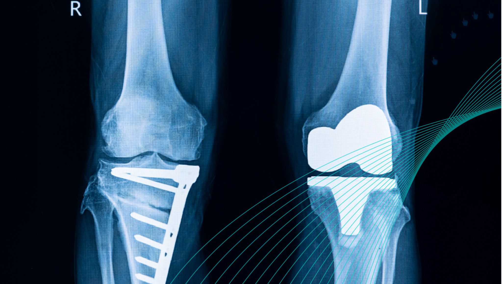 Radiografía de lesión de rodilla que representa el caso del desgarro de Wrisberg